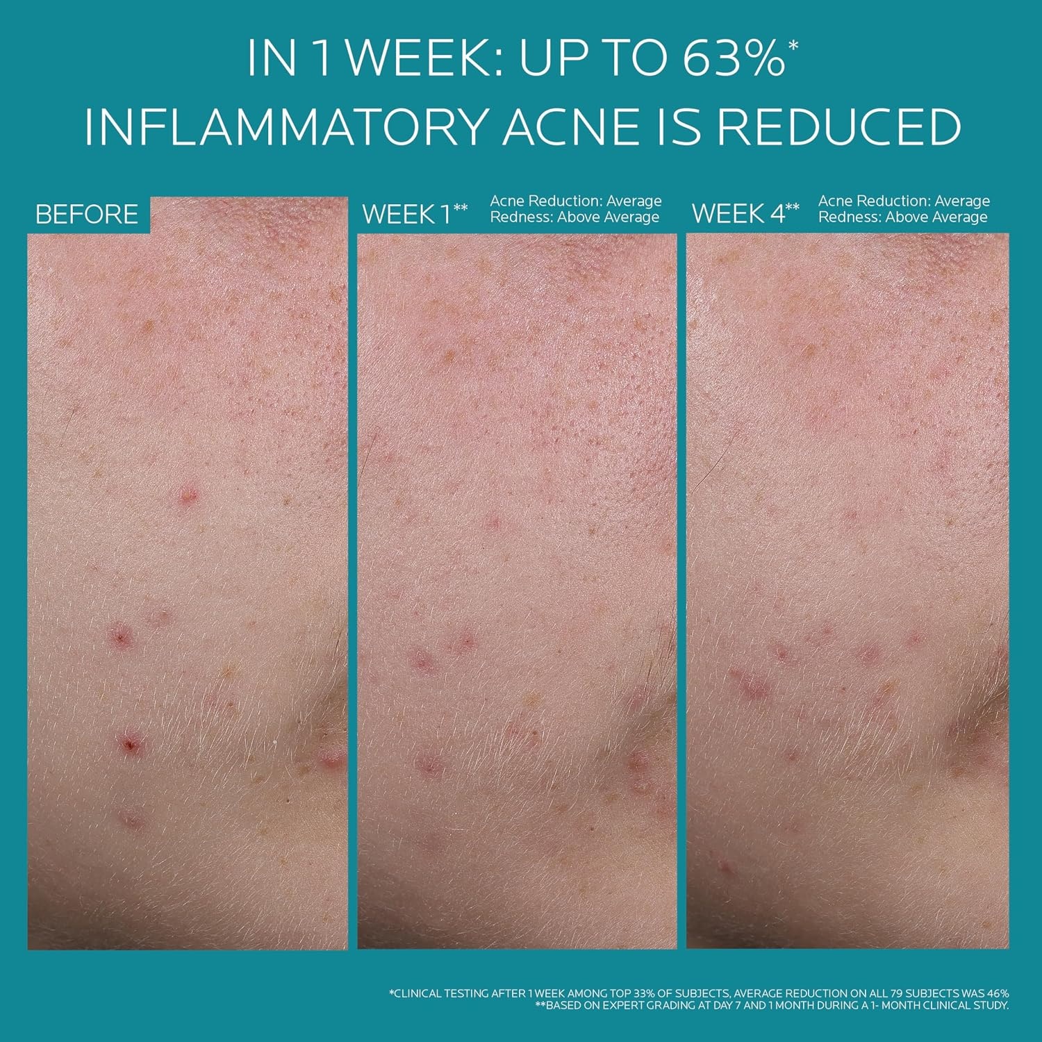 image:imageLa RochePosay Effaclar BPO MultiTarget Acne Treatment Benzoyl Peroxide135 Fl Oz Pack of 1