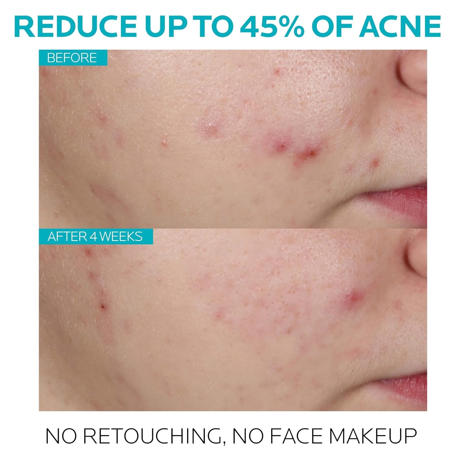 image:imageBundle of La RochePosay Effaclar Salicylic Acid Treatment to Minimize Pores Clear Acne Blemishes and Post Acne Marks Anthelios UV Clear Sunscreen SPF 50 Daily Sunscreen for Face with Azelaic Acid