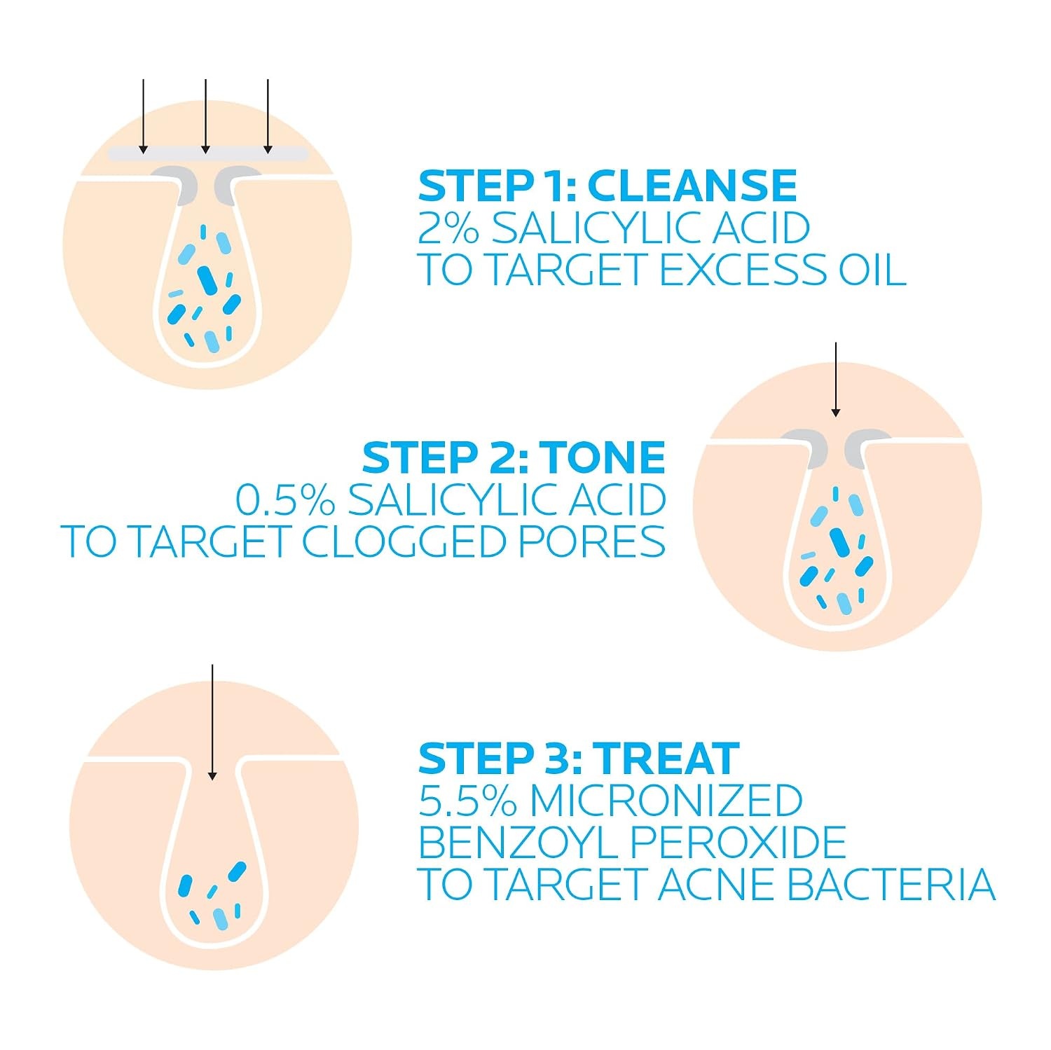 image:imageLa RochePosay Effaclar Dermatological 3 Step Acne Treatment System Salicylic Acid Acne Cleanser Pore Refining Toner and Benzoyl Peroxide Spot Treatment for Sensitive Skin