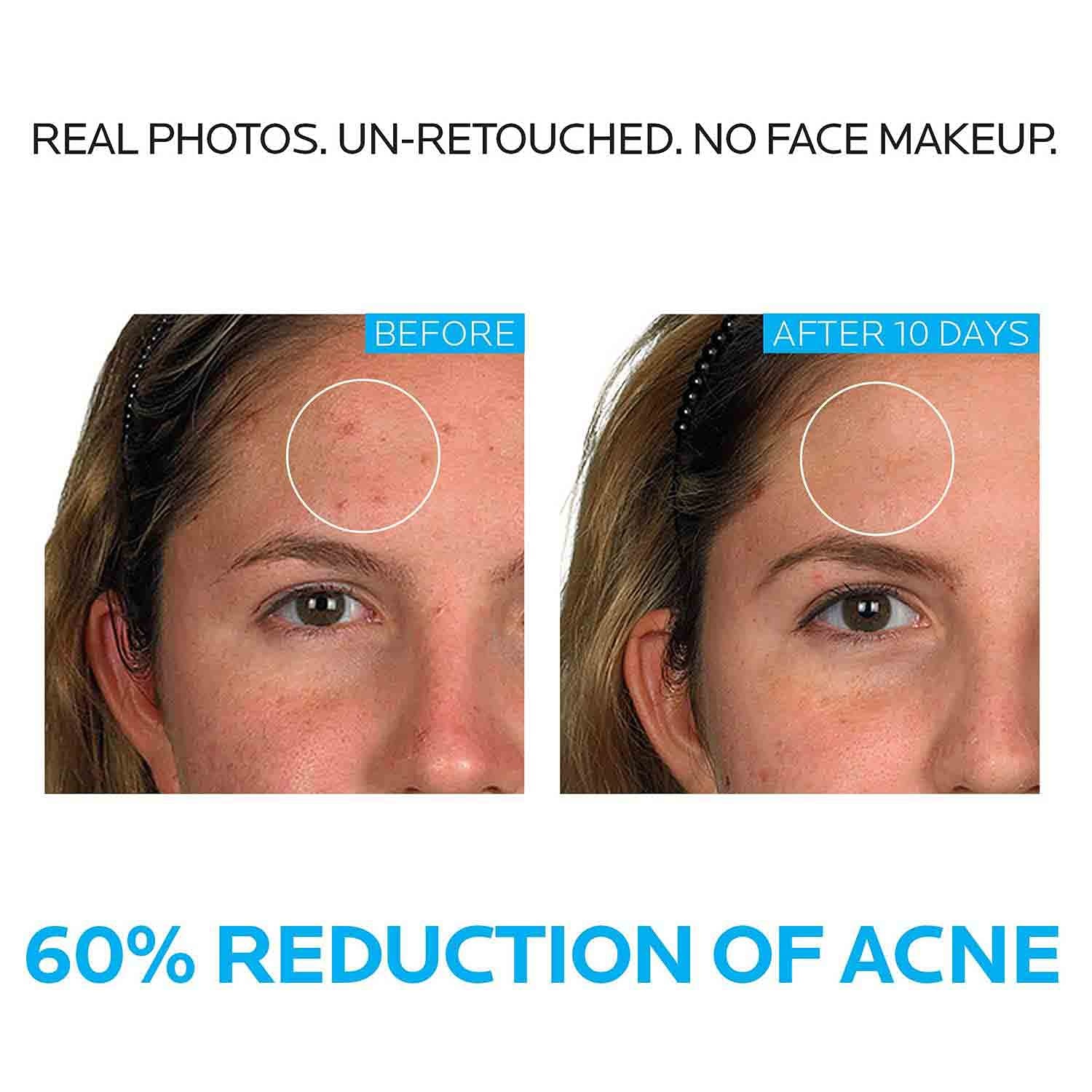 image:imageLa RochePosay Effaclar Dermatological 3 Step Acne Treatment System Salicylic Acid Acne Cleanser Pore Refining Toner and Benzoyl Peroxide Spot Treatment for Sensitive Skin